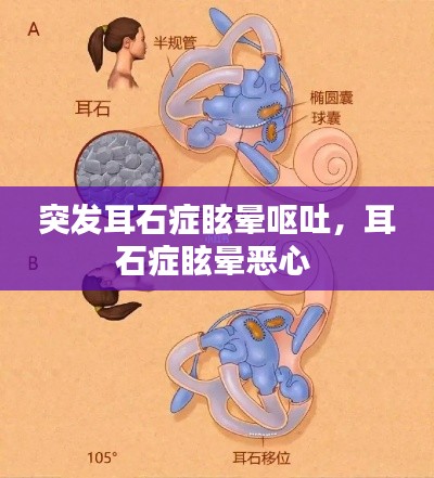 突發耳石癥眩暈嘔吐，耳石癥眩暈惡心 