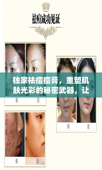 獨(dú)家祛痘痘膏，重塑肌膚光彩的秘密武器，讓你擁有無(wú)瑕美?。? width=